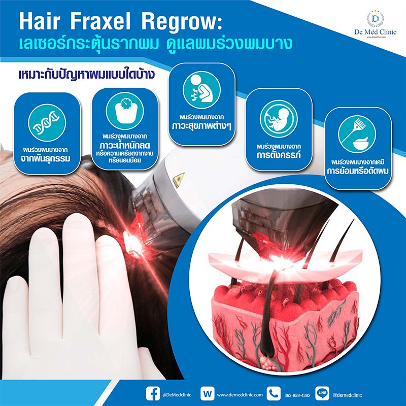 Hair Fraxel Regrow: เลเซอร์กระตุ้นรากผม ดูแลผมร่วงผมบาง Hair Fraxel Regrow: เลเซอร์กระตุ้นรากผม ดูแลผมร่วงผมบาง