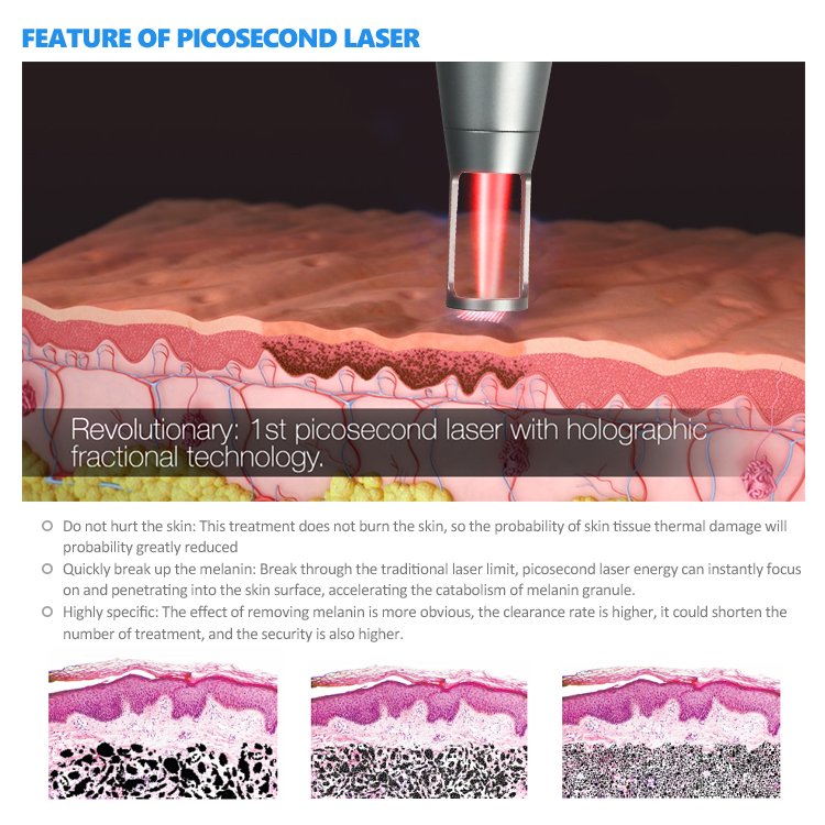 Fractional Picosecond Laser เทคโนโลยีใหม่ล่าสุด ดูแลรูขุมขนกว้าง ริ้วรอยผิวกระจ่างใส