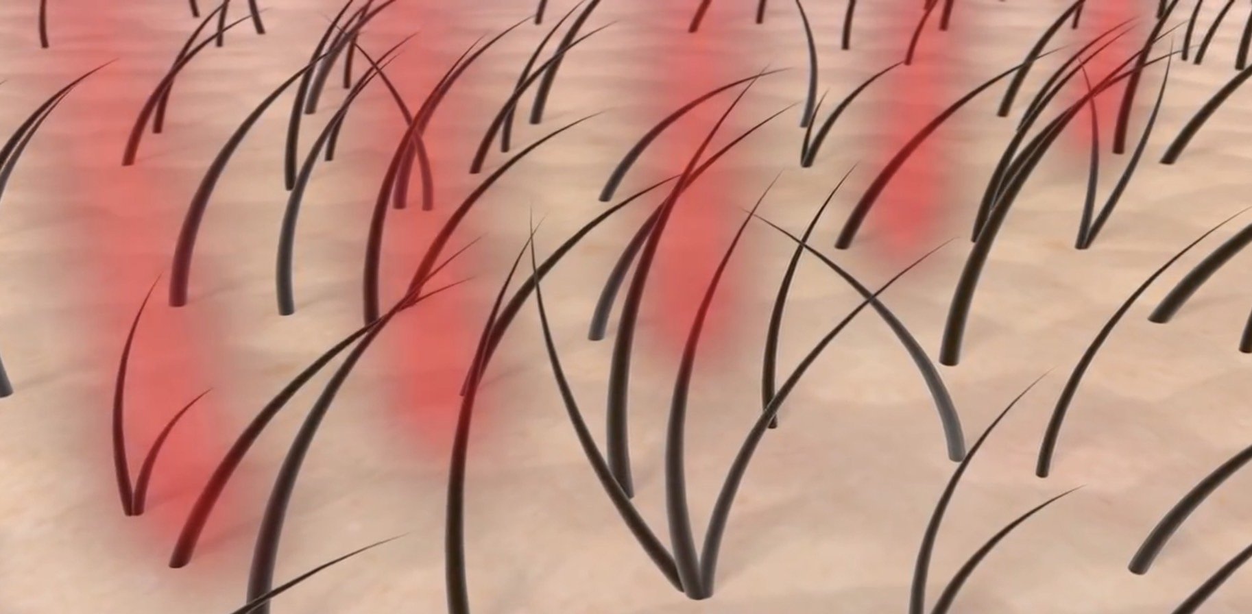 Hair Fraxel Regrow: เลเซอร์กระตุ้นรากผม ดูแลผมร่วงผมบาง Hair Fraxel Regrow: เลเซอร์กระตุ้นรากผม ดูแลผมร่วงผมบาง