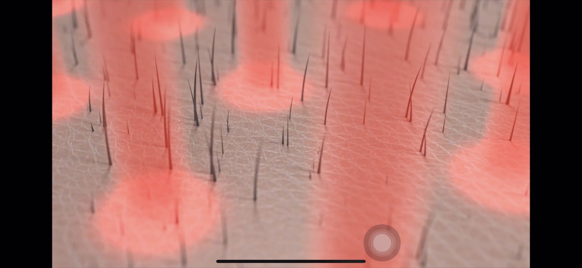 Hair Fraxel Regrow: เลเซอร์กระตุ้นรากผม ดูแลผมร่วงผมบาง Hair Fraxel Regrow: เลเซอร์กระตุ้นรากผม ดูแลผมร่วงผมบาง