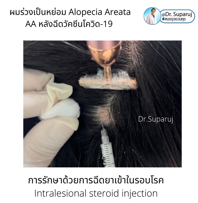 ภาวะผมร่วงเป็นหย่อม Alopecia Areata AA หลังฉีดวัคซีนโควิด-19 เกิดจากอะไรดูแลได้ อย่างไร? ภาวะผมร่วงเป็นหย่อม Alopecia Areata AA หลังฉีดวัคซีนโควิด-19 เกิดจากอะไรดูแลได้ อย่างไร?