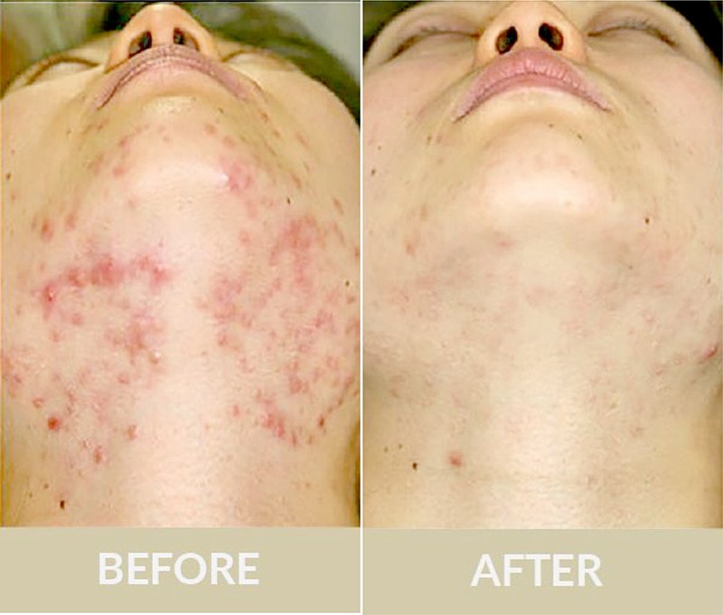 ดูแลรักษาสิวด้วยเทคนิคเข็มคลื่นวิทยุทำลายต่อมไขมัน Micro Insulated Needle RF Acne Resolve ดูแลรักษาสิวด้วยเทคนิคเข็มคลื่นวิทยุทำลายต่อมไขมัน Micro Insulated Needle RF Acne Resolve