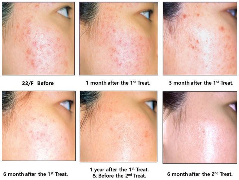 ดูแลรักษาสิวด้วยเทคนิคเข็มคลื่นวิทยุทำลายต่อมไขมัน Micro Insulated Needle RF Acne Resolve