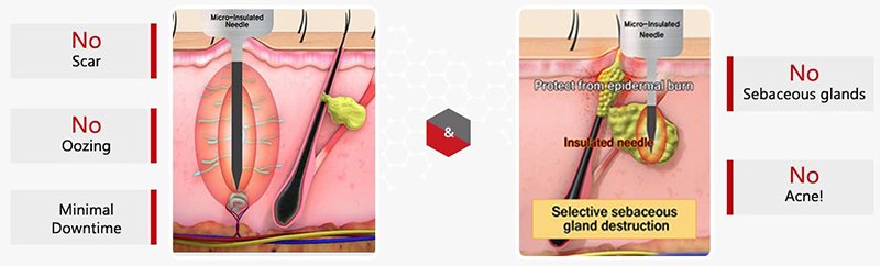 ดูแลรักษาสิวด้วยเทคนิคเข็มคลื่นวิทยุทำลายต่อมไขมัน Micro Insulated Needle RF Acne Resolve ดูแลรักษาสิวด้วยเทคนิคเข็มคลื่นวิทยุทำลายต่อมไขมัน Micro Insulated Needle RF Acne Resolve