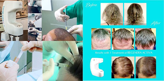 ดูแลผมร่วง ผมบางด้วย Regenera Hair Stem Cell Therapy !! ดูแลผมร่วง ผมบางด้วย Regenera Hair Stem Cell Therapy !!