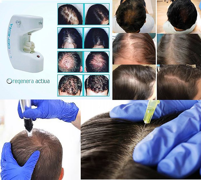 ดูแลผมร่วง ผมบางด้วย Regenera Hair Stem Cell Therapy !!