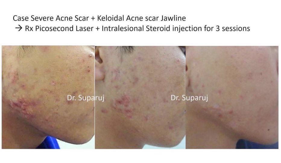 สิวฮอร์โมน สิวรอบเดือน Menstrual Acne, Peroid Acne ดูแลได้อย่างไรบ้าง? สิวฮอร์โมน สิวรอบเดือน Menstrual Acne, Peroid Acne ดูแลได้อย่างไรบ้าง?