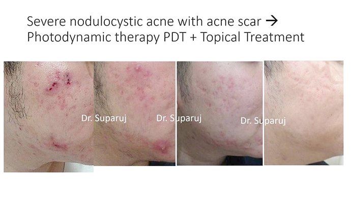 สิวฮอร์โมน สิวรอบเดือน Menstrual Acne, Peroid Acne ดูแลได้อย่างไรบ้าง? สิวฮอร์โมน สิวรอบเดือน Menstrual Acne, Peroid Acne ดูแลได้อย่างไรบ้าง?