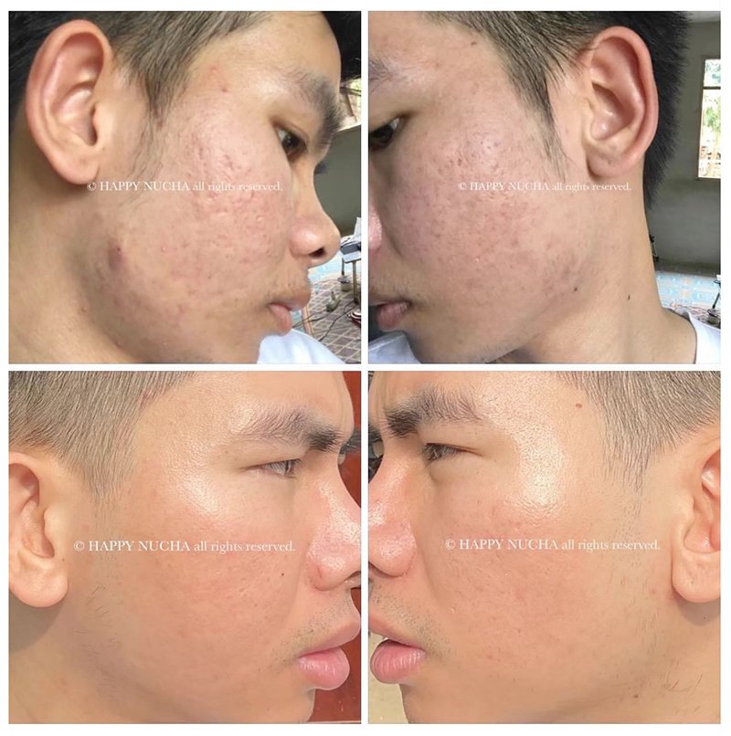 ขอบคุณน้องนุชาที่ให้ความไว้วางใจหมอรุจ ดูแลหลุมสิวให้มาตลอดครับ ขอบคุณน้องนุชาที่ให้ความไว้วางใจหมอรุจ ดูแลหลุมสิวให้มาตลอดครับ