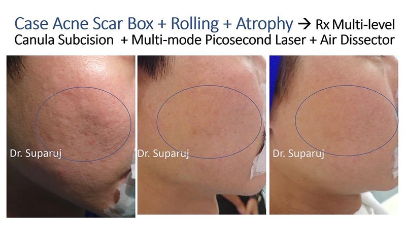 ขอบคุณน้องนุชาที่ให้ความไว้วางใจหมอรุจ ดูแลหลุมสิวให้มาตลอดครับ ขอบคุณน้องนุชาที่ให้ความไว้วางใจหมอรุจ ดูแลหลุมสิวให้มาตลอดครับ