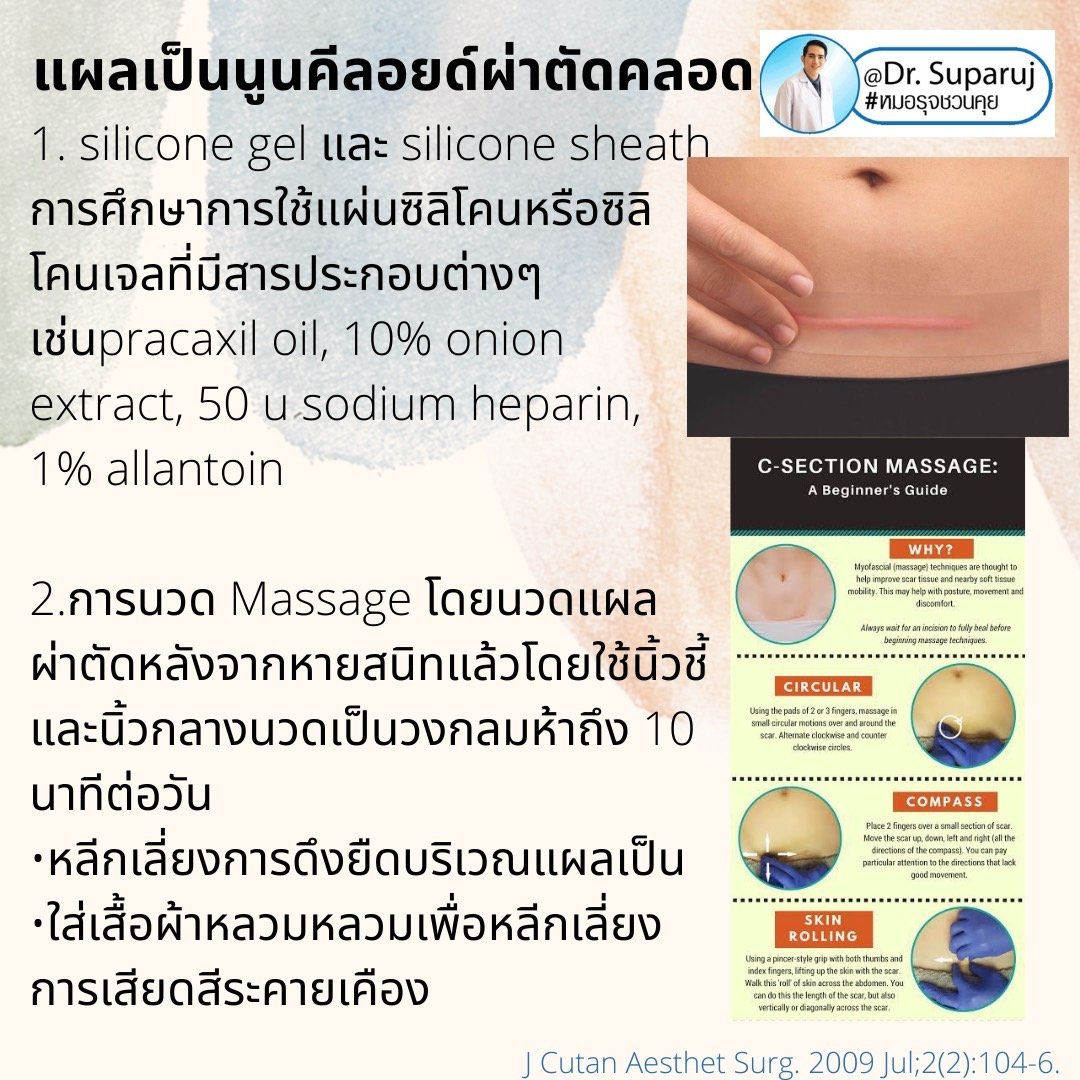 เทคนิคดูแลรักษาแผลเป็นนูนคีลอยด์จากผ่าตัดคลอด Cesarean section scar treatment and prevention เทคนิคดูแลรักษาแผลเป็นนูนคีลอยด์จากผ่าตัดคลอด Cesarean section scar treatment and prevention