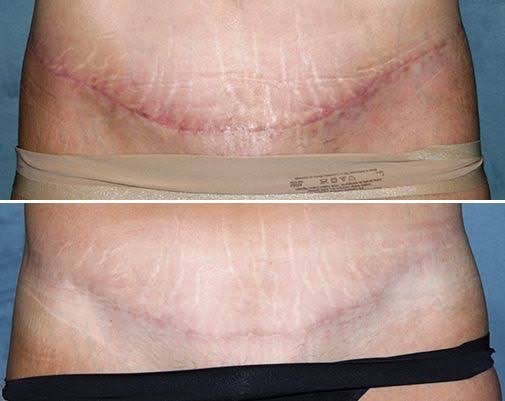 เทคนิคดูแลรักษาแผลเป็นนูนคีลอยด์จากผ่าตัดคลอด Cesarean section scar treatment and prevention เทคนิคดูแลรักษาแผลเป็นนูนคีลอยด์จากผ่าตัดคลอด Cesarean section scar treatment and prevention