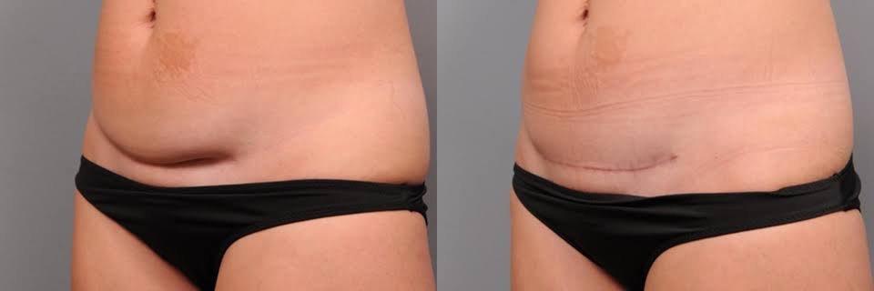 เทคนิคดูแลรักษาแผลเป็นนูนคีลอยด์จากผ่าตัดคลอด Cesarean section scar treatment and prevention เทคนิคดูแลรักษาแผลเป็นนูนคีลอยด์จากผ่าตัดคลอด Cesarean section scar treatment and prevention