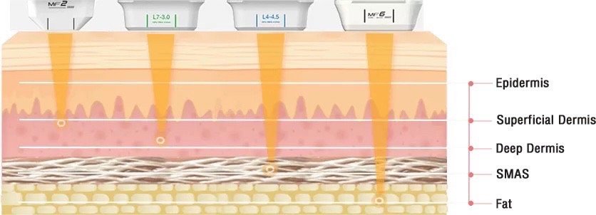 Ultraformer III Body นวัตกรรมสลายไขมันด้วย MMFU กระชับสัดส่วน โดยไม่ต้องผ่าตัด ไม่ต้องพักฟื้น Ultraformer III Body นวัตกรรมสลายไขมันด้วย MMFU กระชับสัดส่วน โดยไม่ต้องผ่าตัด ไม่ต้องพักฟื้น