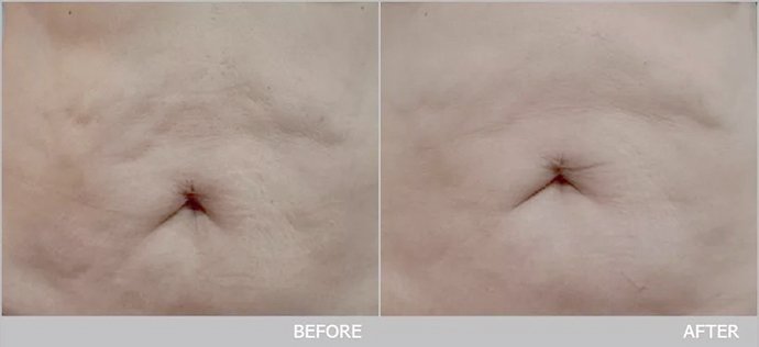 Ultraformer III Body นวัตกรรมสลายไขมันด้วย MMFU กระชับสัดส่วน โดยไม่ต้องผ่าตัด ไม่ต้องพักฟื้น Ultraformer III Body นวัตกรรมสลายไขมันด้วย MMFU กระชับสัดส่วน โดยไม่ต้องผ่าตัด ไม่ต้องพักฟื้น