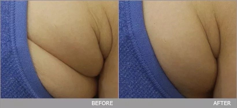 Ultraformer III Body นวัตกรรมสลายไขมันด้วย MMFU กระชับสัดส่วน โดยไม่ต้องผ่าตัด ไม่ต้องพักฟื้น Ultraformer III Body นวัตกรรมสลายไขมันด้วย MMFU กระชับสัดส่วน โดยไม่ต้องผ่าตัด ไม่ต้องพักฟื้น