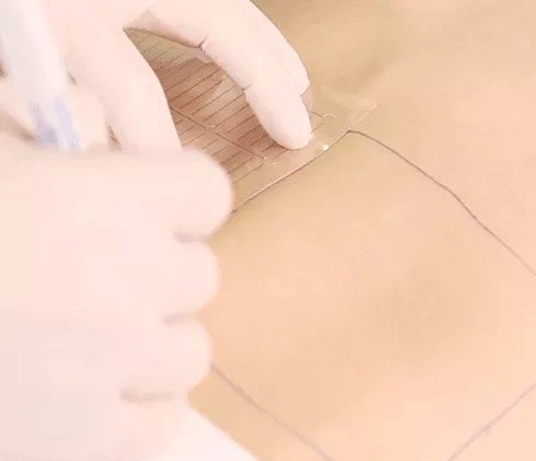 Ultraformer III Body นวัตกรรมสลายไขมันด้วย MMFU กระชับสัดส่วน โดยไม่ต้องผ่าตัด ไม่ต้องพักฟื้น Ultraformer III Body นวัตกรรมสลายไขมันด้วย MMFU กระชับสัดส่วน โดยไม่ต้องผ่าตัด ไม่ต้องพักฟื้น