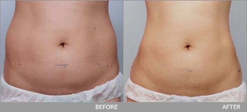 Ultraformer III Body นวัตกรรมสลายไขมันด้วย MMFU กระชับสัดส่วน โดยไม่ต้องผ่าตัด ไม่ต้องพักฟื้น Ultraformer III Body นวัตกรรมสลายไขมันด้วย MMFU กระชับสัดส่วน โดยไม่ต้องผ่าตัด ไม่ต้องพักฟื้น