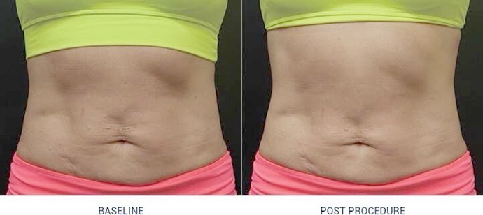 Ultraformer III Body นวัตกรรมสลายไขมันด้วย MMFU กระชับสัดส่วน โดยไม่ต้องผ่าตัด ไม่ต้องพักฟื้น Ultraformer III Body นวัตกรรมสลายไขมันด้วย MMFU กระชับสัดส่วน โดยไม่ต้องผ่าตัด ไม่ต้องพักฟื้น