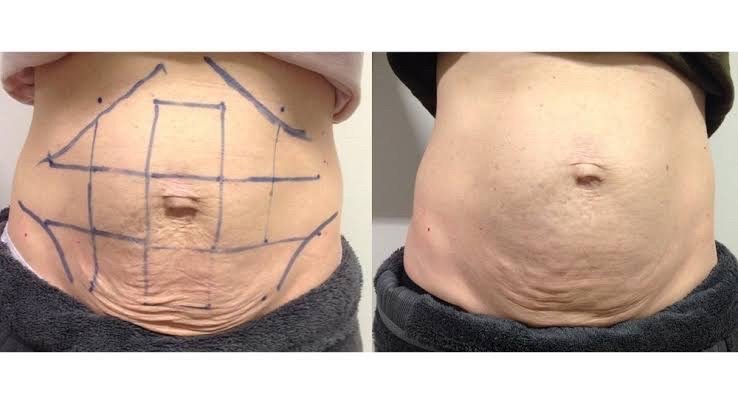 Ultraformer III Body นวัตกรรมสลายไขมันด้วย MMFU กระชับสัดส่วน โดยไม่ต้องผ่าตัด ไม่ต้องพักฟื้น Ultraformer III Body นวัตกรรมสลายไขมันด้วย MMFU กระชับสัดส่วน โดยไม่ต้องผ่าตัด ไม่ต้องพักฟื้น