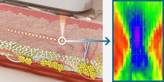 Ultraformer III Body นวัตกรรมสลายไขมันด้วย MMFU กระชับสัดส่วน โดยไม่ต้องผ่าตัด ไม่ Ultraformer III Body นวัตกรรมสลายไขมันด้วย MMFU กระชับสัดส่วน โดยไม่ต้องผ่าตัด ไม่