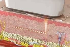 Ultraformer III Body นวัตกรรมสลายไขมันด้วย MMFU กระชับสัดส่วน โดยไม่ต้องผ่าตัด ไม่ Ultraformer III Body นวัตกรรมสลายไขมันด้วย MMFU กระชับสัดส่วน โดยไม่ต้องผ่าตัด ไม่