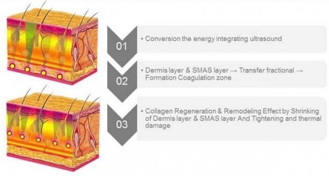 Ultraformer III Body นวัตกรรมสลายไขมันด้วย MMFU กระชับสัดส่วน โดยไม่ต้องผ่าตัด ไม่ต้องพักฟื้น Ultraformer III Body นวัตกรรมสลายไขมันด้วย MMFU กระชับสัดส่วน โดยไม่ต้องผ่าตัด ไม่ต้องพักฟื้น