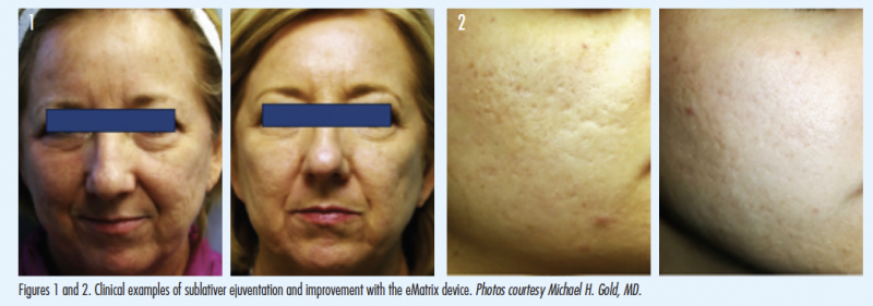 Fractional Radio Frequency RF คืออะไร มีกี่ชนิด แตกต่างกันอย่างไร ? Fractional Radio Frequency RF คืออะไร มีกี่ชนิด แตกต่างกันอย่างไร ?