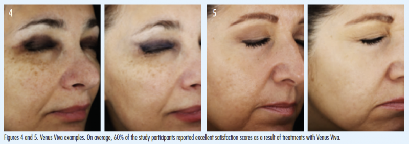 Fractional Radio Frequency RF คืออะไร มีกี่ชนิด แตกต่างกันอย่างไร ? Fractional Radio Frequency RF คืออะไร มีกี่ชนิด แตกต่างกันอย่างไร ?