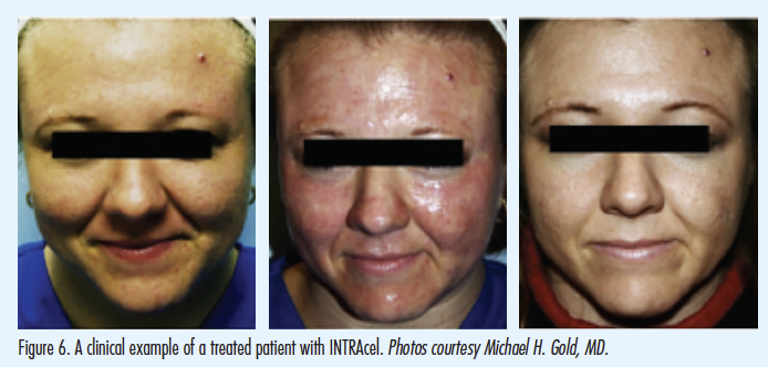 Fractional Radio Frequency RF คืออะไร มีกี่ชนิด แตกต่างกันอย่างไร ? Fractional Radio Frequency RF คืออะไร มีกี่ชนิด แตกต่างกันอย่างไร ?