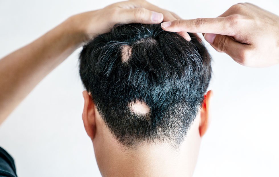 ภาวะผมร่วงเป็นหย่อม Alopecia Areata AA หลังฉีดวัคซีนโควิด-19 เกิดจากอะไรดูแลได้ อย่างไร? ภาวะผมร่วงเป็นหย่อม Alopecia Areata AA หลังฉีดวัคซีนโควิด-19 เกิดจากอะไรดูแลได้ อย่างไร?