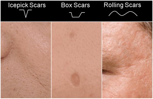 การรักษารอยแผลเป็นแบบหลุมจากสิว Atrophic Acne Scar ด้วยการผ่าตัด Scar Revision คืออะไร ? การรักษารอยแผลเป็นแบบหลุมจากสิว Atrophic Acne Scar ด้วยการผ่าตัด Scar Revision คืออะไร ?