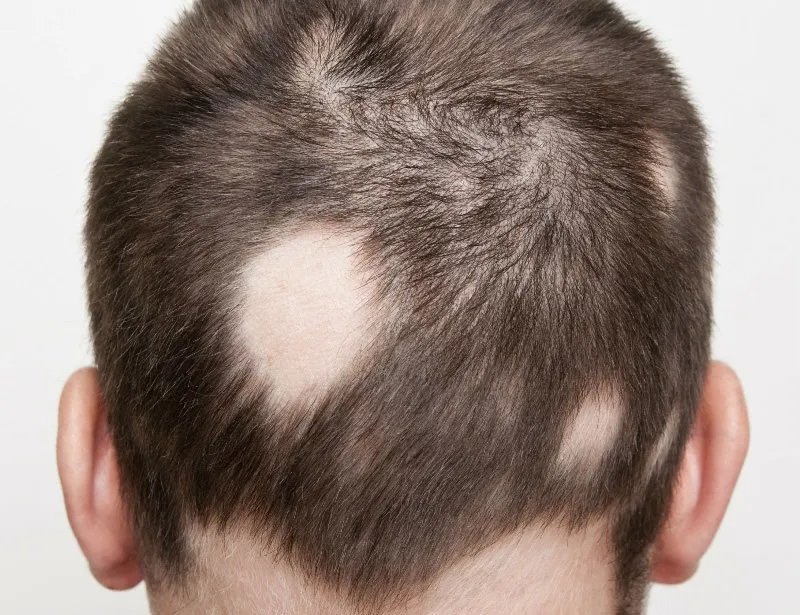 ภาวะผมร่วงเป็นหย่อม Alopecia Areata AA หลังฉีดวัคซีนโควิด-19 เกิดจากอะไรดูแลได้ อย่างไร? ภาวะผมร่วงเป็นหย่อม Alopecia Areata AA หลังฉีดวัคซีนโควิด-19 เกิดจากอะไรดูแลได้ อย่างไร?