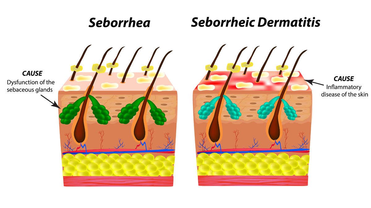 โรคหนังศีรษะอักเสบจากต่อมไขมันอักเสบ (SEBORRHEIC DERMATITIS) คืออะไร? โรคหนังศีรษะอักเสบจากต่อมไขมันอักเสบ (SEBORRHEIC DERMATITIS) คืออะไร?