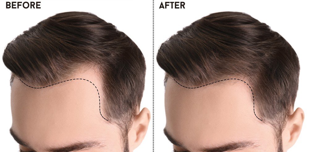 การปลูกผม (Hair Transplantation) คืออะไร การปลูกผม (Hair Transplantation) คืออะไรการปลูกผม (Hair Transplantation) คืออะไร