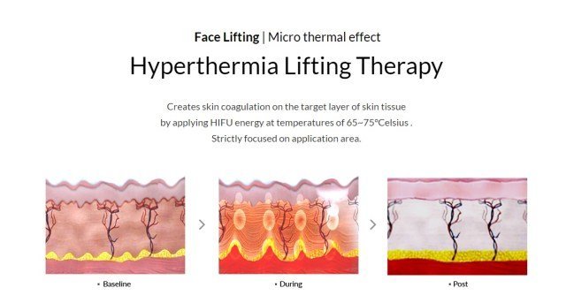 Ultraformer III HIFU MMFU นวัตกรรมใหม่ล่าสุดของการยกกระชับ Ultraformer III HIFU MMFU นวัตกรรมใหม่ล่าสุดของการยกกระชับ