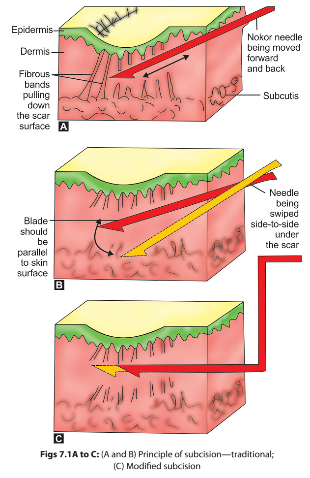 การรักษารอยแผลเป็นแบบหลุมจากสิว Atrophic Acne Scar ด้วยการผ่าตัด Scar Revision คืออะไร ? การรักษารอยแผลเป็นแบบหลุมจากสิว Atrophic Acne Scar ด้วยการผ่าตัด Scar Revision คืออะไร ?