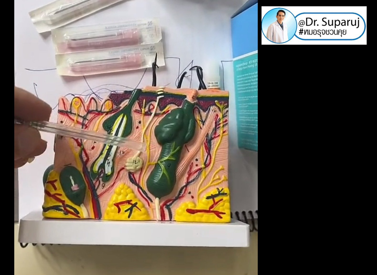 Update เทคนิค Subcision ตัดพังผืดรักษาหลุมสิว Acne Scar Subcision Techniques Update เทคนิค Subcision ตัดพังผืดรักษาหลุมสิว Acne Scar Subcision Techniques