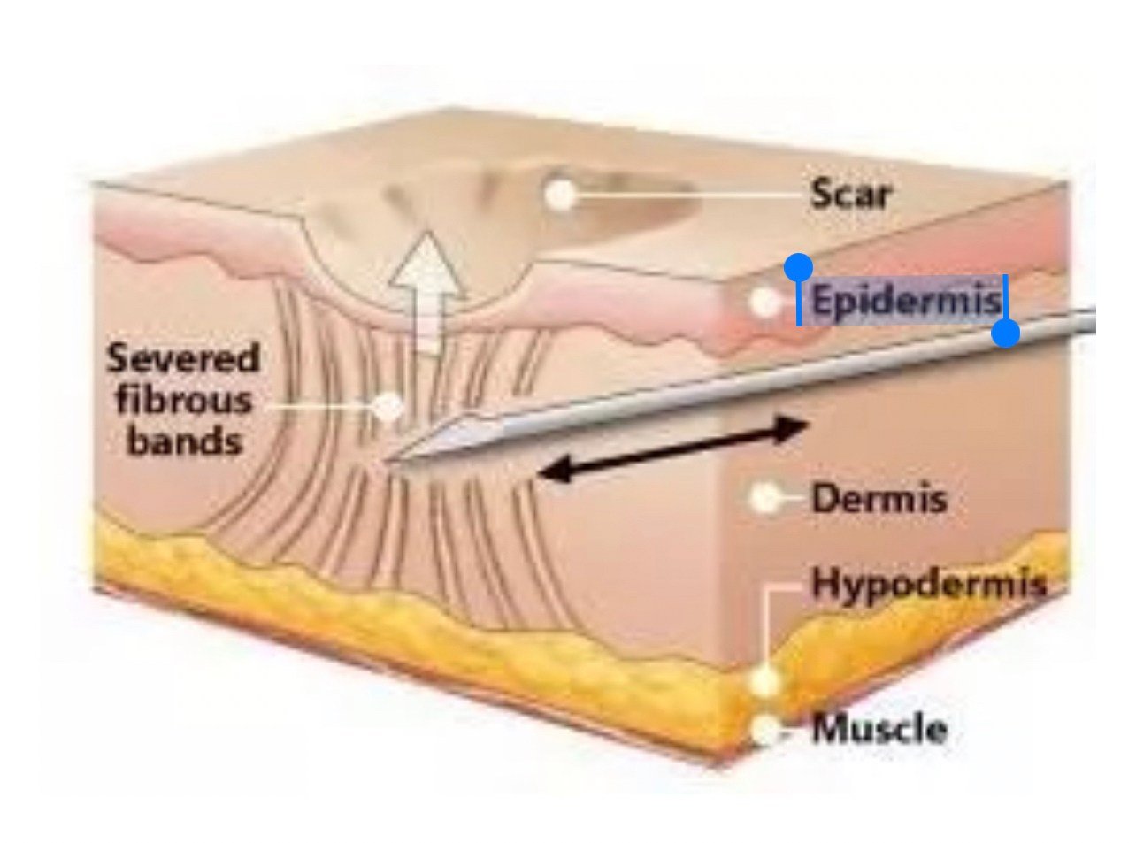 Update เทคนิค Subcision ตัดพังผืดรักษาหลุมสิว Acne Scar Subcision Techniques