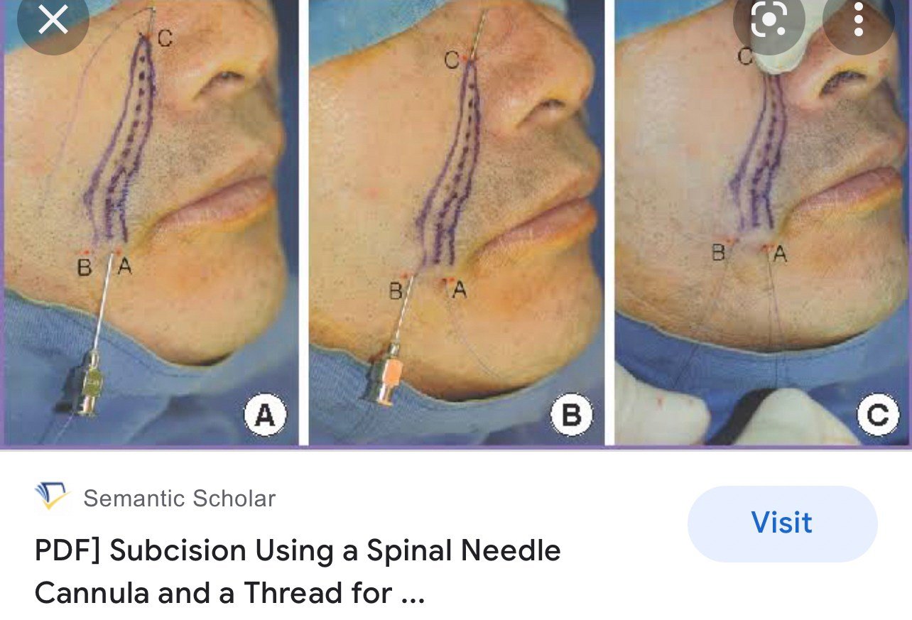 Update เทคนิค Subcision ตัดพังผืดรักษาหลุมสิว Acne Scar Subcision Techniques Update เทคนิค Subcision ตัดพังผืดรักษาหลุมสิว Acne Scar Subcision Techniques