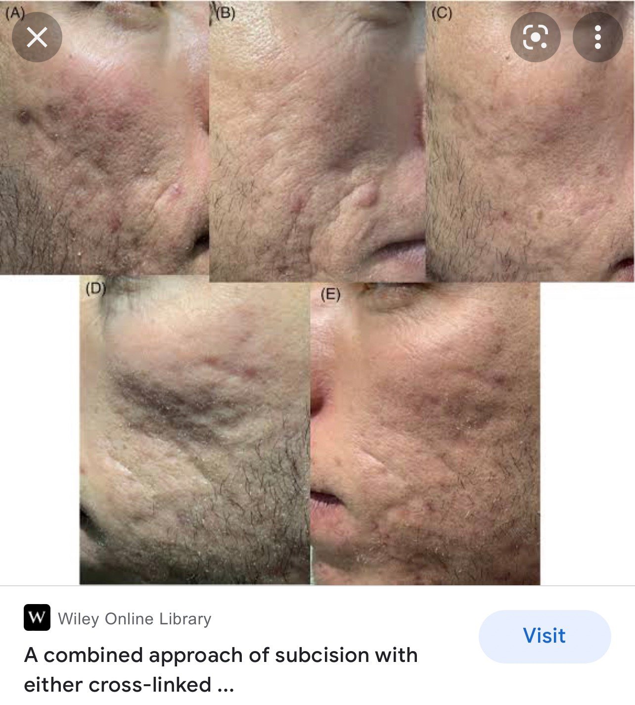 Update เทคนิค Subcision ตัดพังผืดรักษาหลุมสิว Acne Scar Subcision Techniques