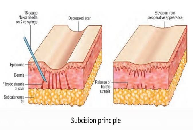 Update เทคนิค Subcision ตัดพังผืดรักษาหลุมสิว Acne Scar Subcision Techniques Update เทคนิค Subcision ตัดพังผืดรักษาหลุมสิว Acne Scar Subcision Techniques