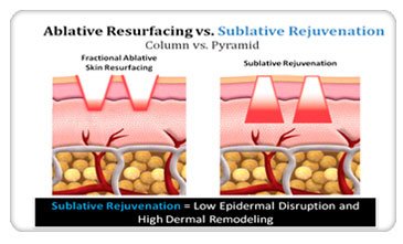 Fractional Radio Frequency RF คืออะไร มีกี่ชนิด แตกต่างกันอย่างไร ? Fractional Radio Frequency RF คืออะไร มีกี่ชนิด แตกต่างกันอย่างไร ?