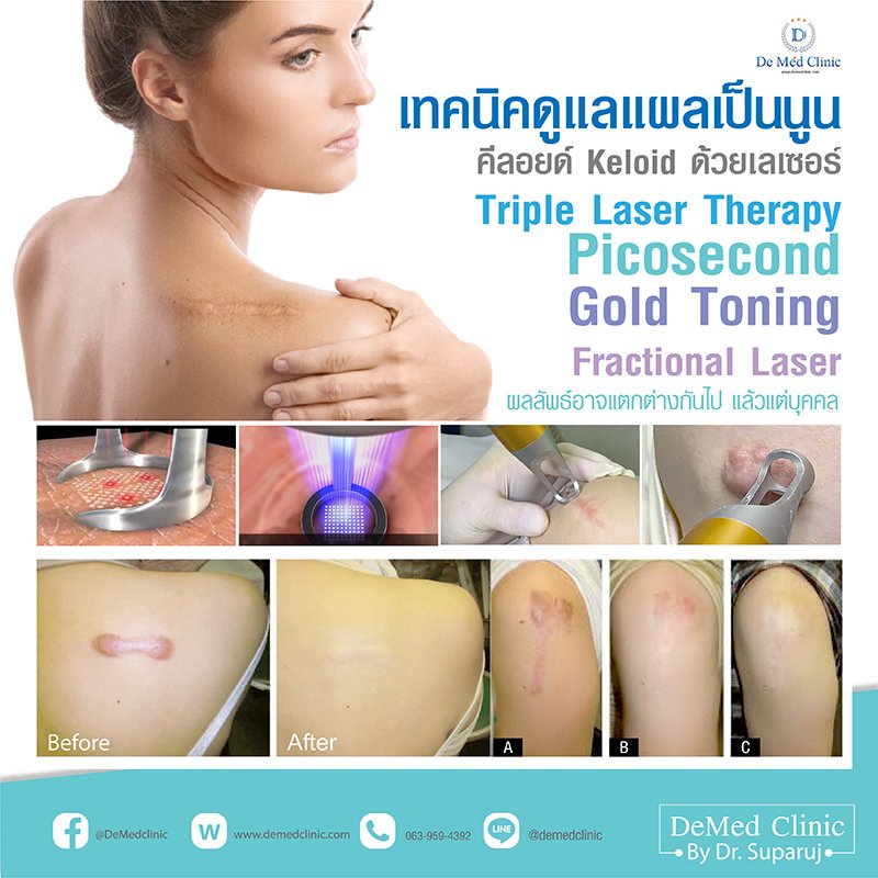 เทคนิคดูแลแผลเป็นนูน คีลอยด์ Keloid ด้วยเลเซอร์ Triple Laser Therapy: Picosecond + Gold Toning + Fractional Laser เทคนิคดูแลแผลเป็นนูน คีลอยด์ Keloid ด้วยเลเซอร์ Triple Laser Therapy: Picosecond + Gold Toning + Fractional Laser