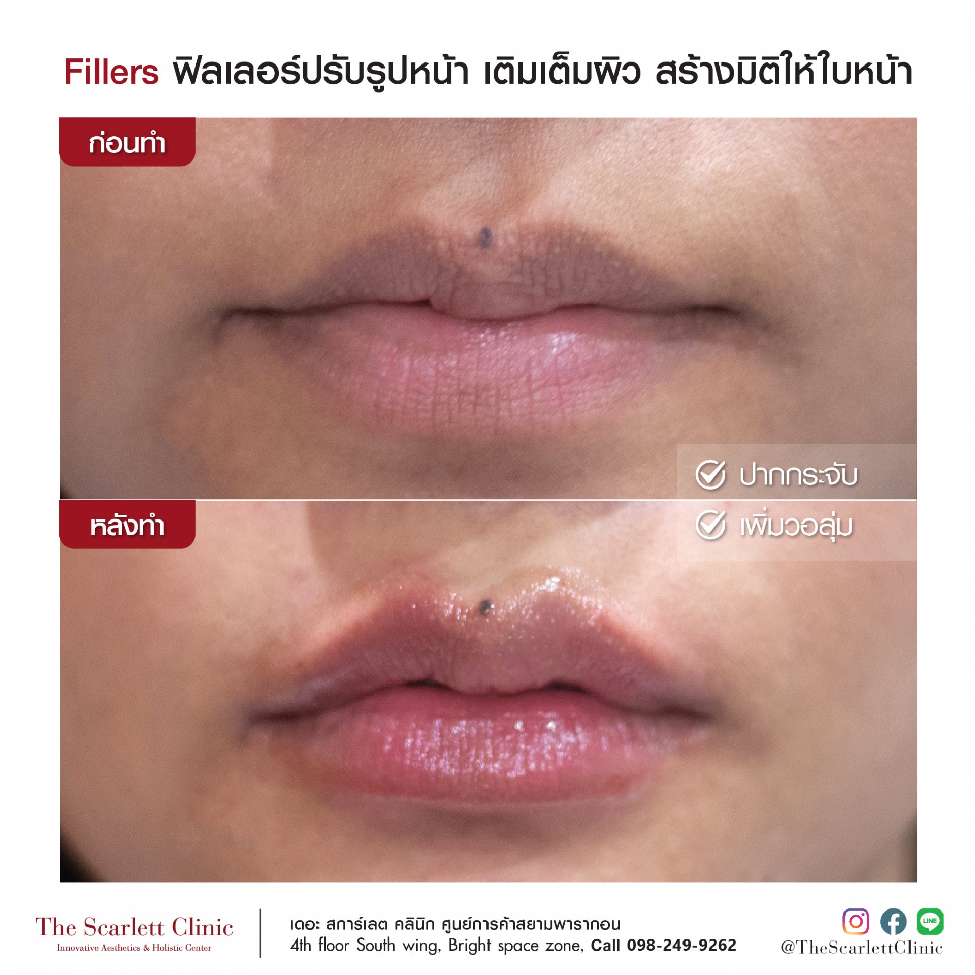 Review Facial Design by Fillers