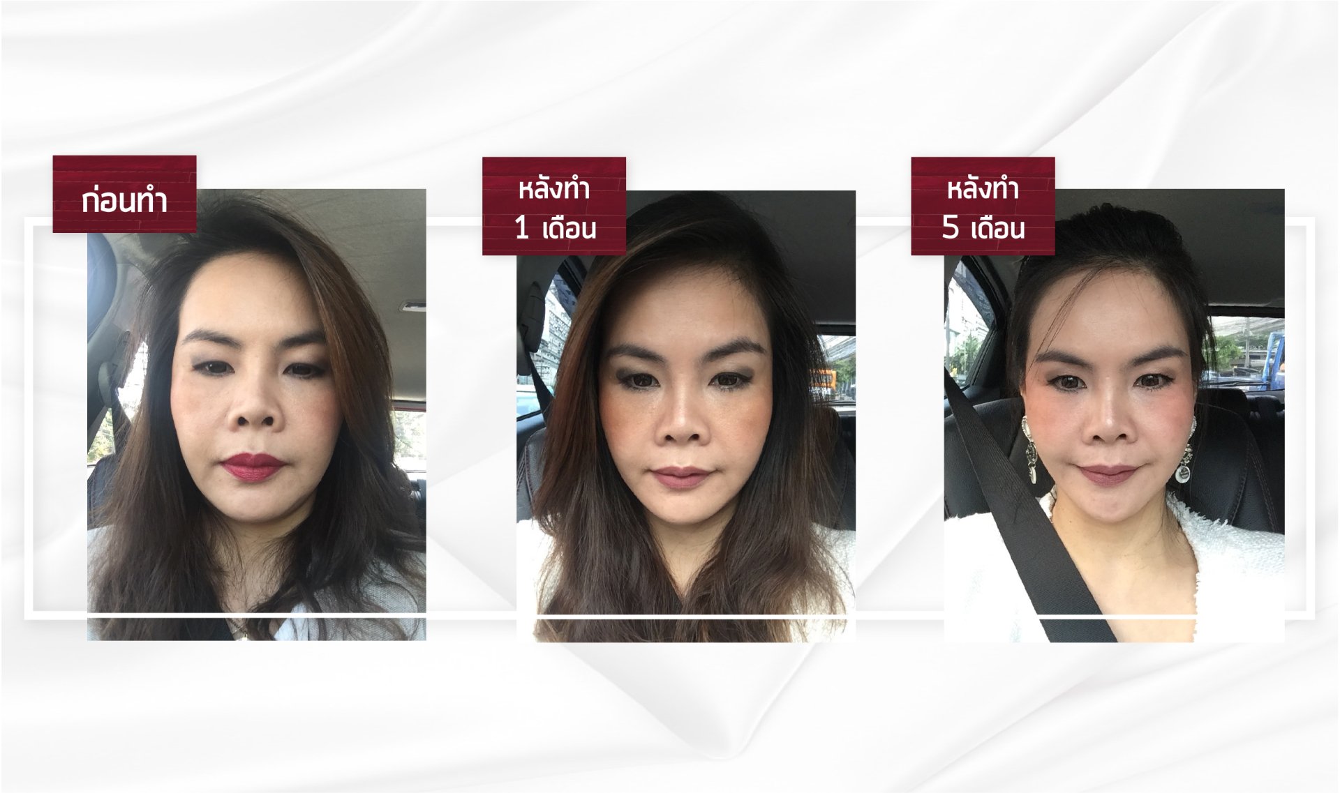 ultherapy, ulthera, อัลเทอร่า, ยกกระชับผิว