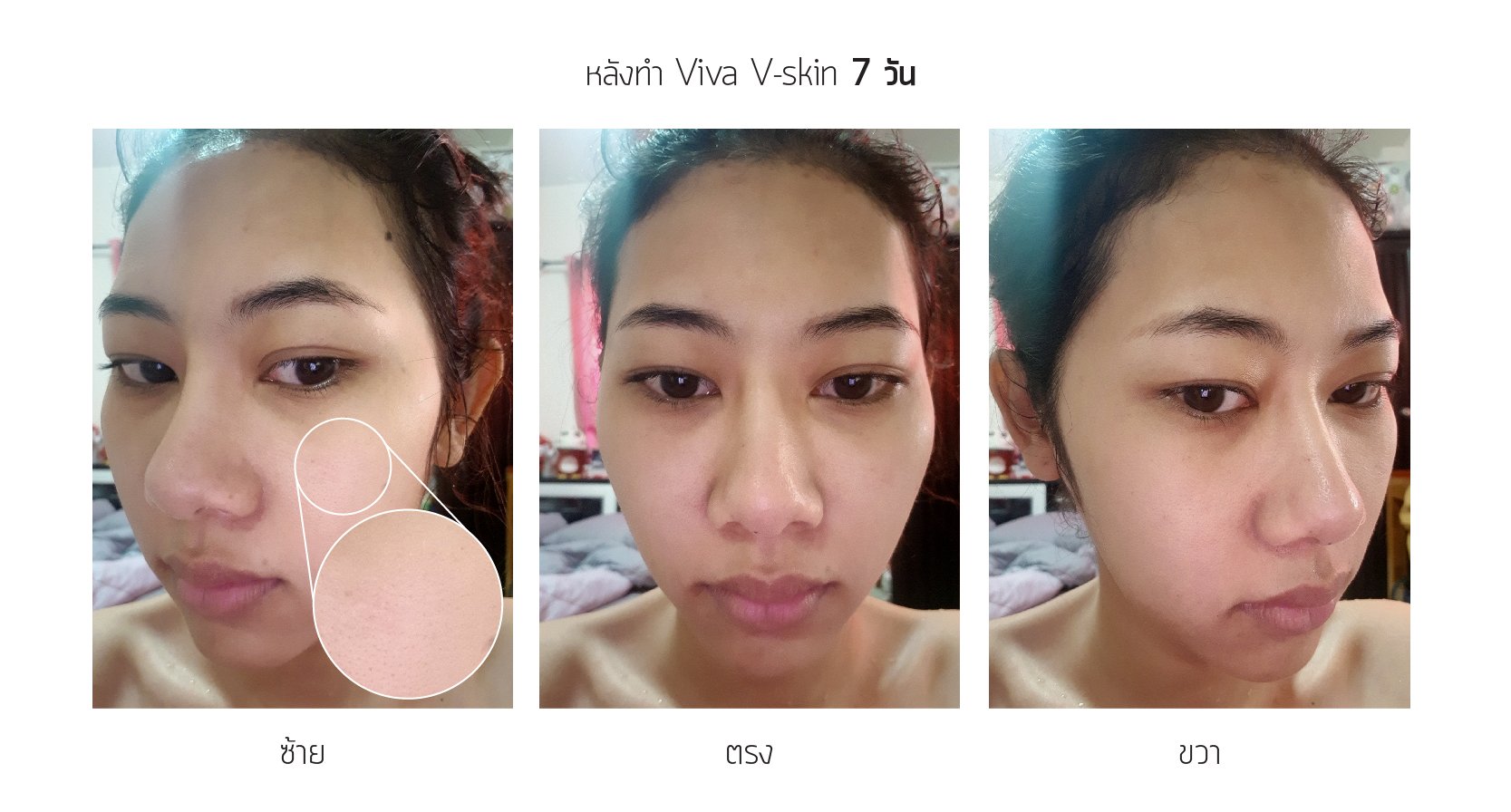 venue viva, รักษาหลุมสิว