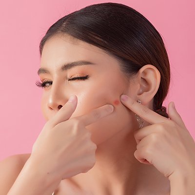 การปฏิบัติตัวเมื่อเป็นสิวอักเสบ