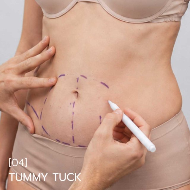 Tummy Tuck