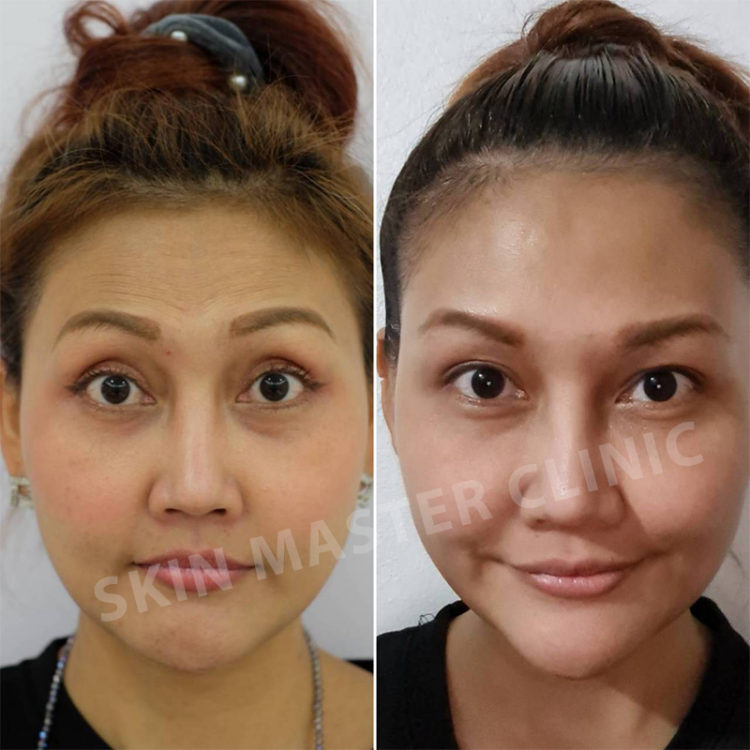 Review BOTOX - skinmaster-clinic